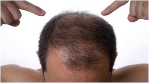 3 Facts About Hair Systems You May Not Have Known